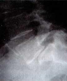 Рентгенограмма показывает смещенный позвонок спондилолистез От обычного - фото 24
