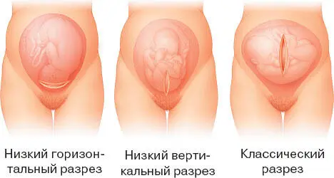 ПРОХОЖДЕНИЕ ЧЕРЕЗ РОДОВЫЕ ПУТИ Удлинение головки Роднички КАК ЭТО ДЕЛАЕТСЯ - фото 161