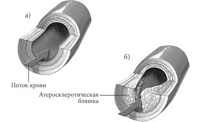 Рис 9 Артерии а здоровая б суженная артерия при атеросклерозе Отметим - фото 9