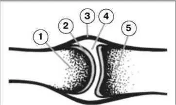 Рис 21 Схема сустава 1 головка сустава 2 хрящ 3 суставная сумка 4 - фото 6