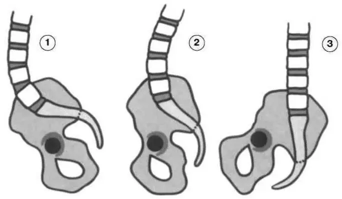 Рис 310 Положения таза 1 опрокинутый вперед 2 в средней позиции 3 - фото 23