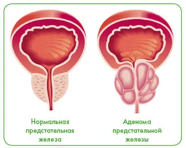 Сужение просвета мочеиспускательного канала происходит постепенно - фото 3