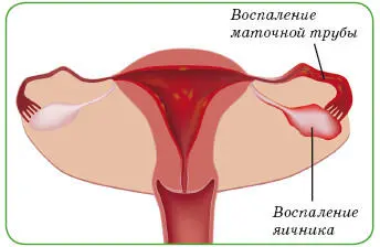 Проявления острого аднексита и выраженного обострения хронического воспаления - фото 6