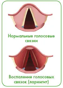 Его развитию способствуют переохлаждение перенапряжение голоса курение - фото 127