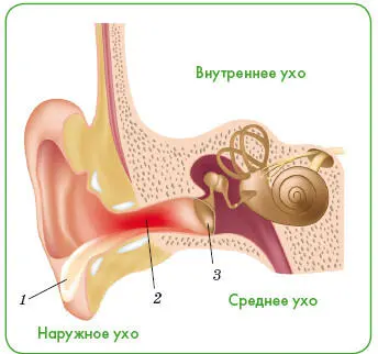 Наружный отит 1 отделяемое из уха 2 воспаление наружного слухового - фото 153