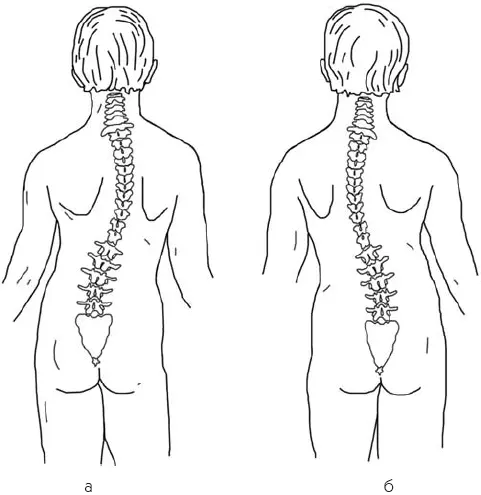 Рис 52Правосторонний а и левосторонний б сколиоз В течение столетий врачи - фото 74