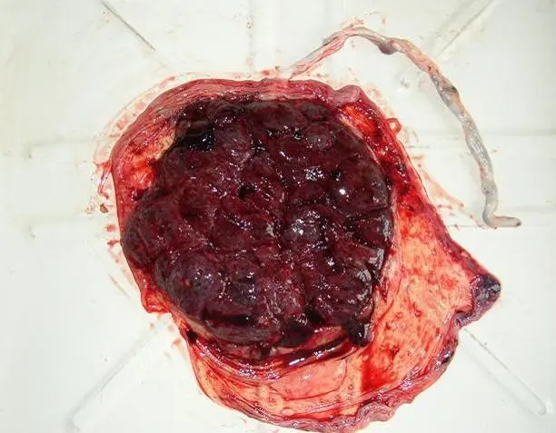 Материнская поверхность последа Послед выделяется Рождение последа - фото 14