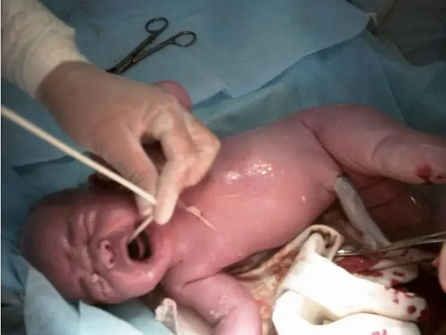 Отсасывание слизи из верхних дыхательных путей Обработка пуповины - фото 17