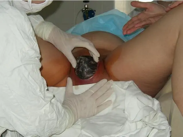 Головка плода прорезывается Головка плода прорезалась Наружный поворот - фото 10