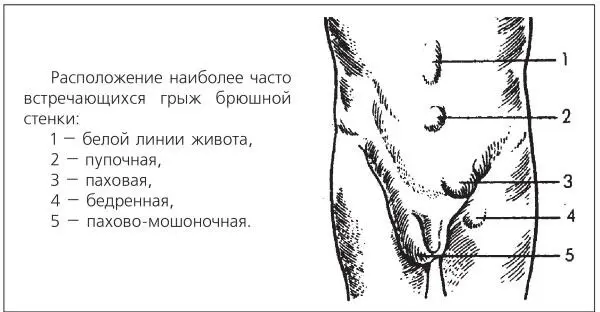 Расположение наиболее часто встречающихся грыж брюшной стенки 1 белой линии - фото 41