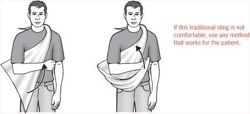 A full sling should be used for any injury to the lower part of the arm or to - фото 30