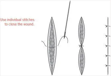 Butterfly stitches which are actually plasters require even more deftness - фото 33