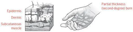 Thirddegree burnsare deep affecting all the layers of skin and may reach - фото 37