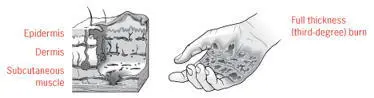 Minor burns In this category are first and seconddegree burns These should - фото 38