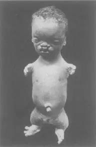 ROBERTSS SYNDROME STILLBORN INFANT FROM BC HIRST AND GA PIERSOL 1893 - фото 4