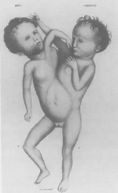 CONJOINED TWINS PARAPAGUS DICEPHALUS TETRABRACHIUS RITTA AND CHRISTINA PARODI - фото 6