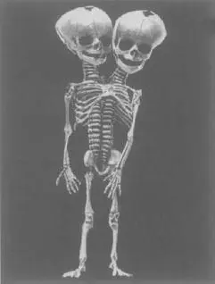 CONJOINED TWINS PARAPAGUS DICEPHALUS DIBRACHIUS FROM BC HIRST AND GA - фото 8