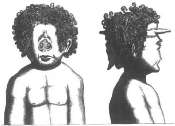 CYCLOPIA WITH CONJOINED TWINNING ATTRIBUTED TO LEONARDO DA VINCI FROM - фото 14