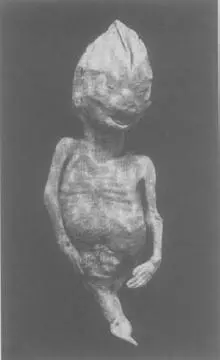 SIRENOMELIA OR MERMAID SYNDROME IN A STILLBORN FOETUS FROM B C HIRST AND G - фото 19