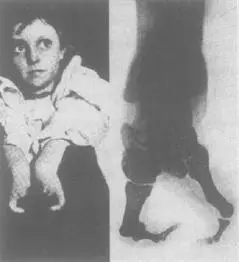 SPLITHANDSPLITFOOT OR ECTRODACYTLY OR LOBSTERCLAW SYNDROME GIRL WITH - фото 24