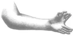 MIRRORIMAGE POLYDACTYLY LEFT HAND OF A WOMAN WITH EIGHT DIGITS FROM WLLLIAM - фото 27