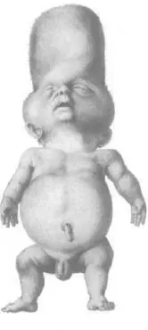 THANATOPHORIC DYSPLASIA STILLBORN INFANT AMSTERDAM c 1847 FROM WILLEM - фото 28