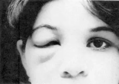 Figure 4 Child with Romañas sign a chagoma that occurs at the site of the - фото 4