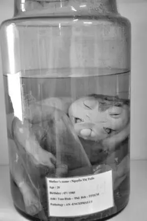 Anencephalus baby born with a substantial part of its brain missing The - фото 22