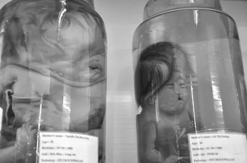 Hydrocephalus babies born with water on the brain Ive read about Dr - фото 23