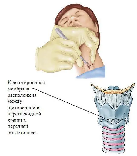 Нормализация дренирования мокроты Все методы нормализации дренирования - фото 4