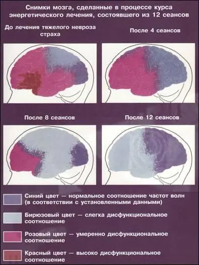 Электроэнцефалограмма обеспечивает визуальную запись электрической активности - фото 57