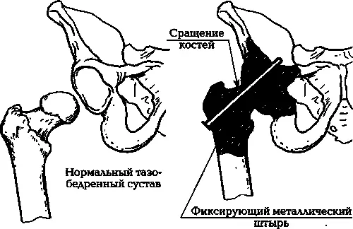 Илл 8 Операция артродеза Кроме того на коленных суставах проводится еще - фото 12