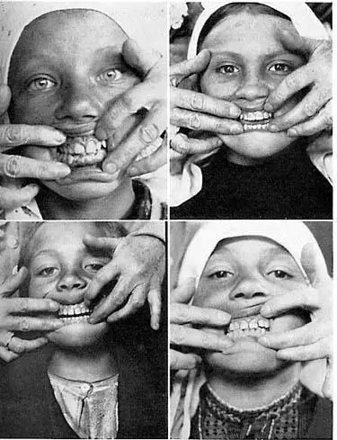 Рис 3 Нормальное развитие лица и зубных дуг при натуральном питании родителей - фото 3