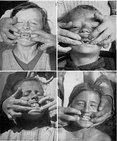 Рис 4 In the modernized districts of Switzerland tooth decay is rampant The - фото 4