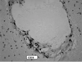 Dr Najjar explained that the brain biopsy picture showed a blood vessel under - фото 68