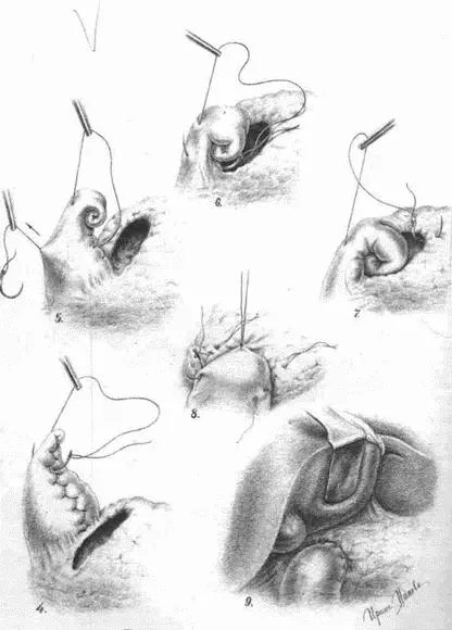 Рис 28Операция улитки Последовательные этапы образования улитки из - фото 45