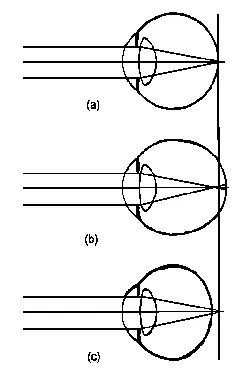 Figures A24 Schemes Showing the Refraction Rays in the Eyes a Normal b - фото 29