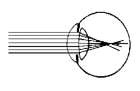 Figure A25 Scheme showing the Refraction of Rays in an Astigmatic Eye 2 - фото 30