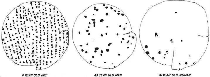 Figure 210The density of Meissners corpuscles decreases with age in the - фото 37