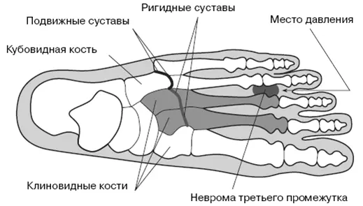 Рис 41 Плюсневые кости и связанные с ними проблемы Вторая вероятная причина - фото 8