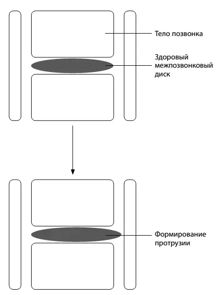 Формирование грыжи позвоночника 1 Позвоночник это не только костный - фото 5