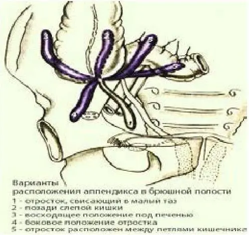 Рис 16 Варианты расположения аппендикса 1 нисходящее положение 2 - фото 17