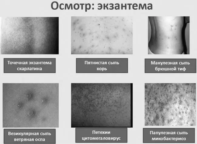 Необходимо выяснить наличие контактов с инфекционными больными с подобными - фото 4