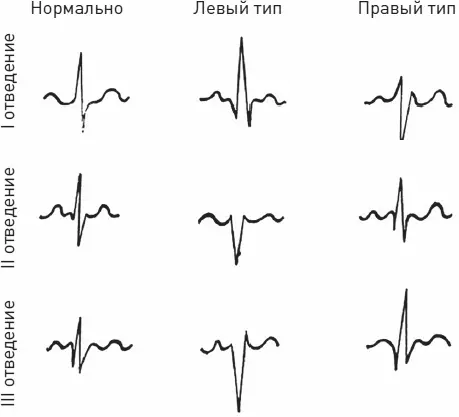 Рис 16 Схема различных вариантов электрической оси сердца нормально левый - фото 17