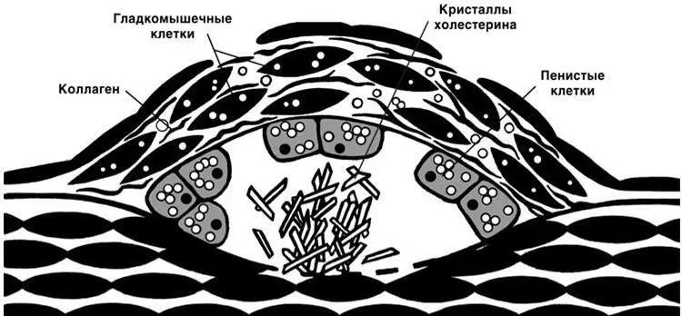 Рис 13 Схема атеросклеротической бляшки по G R Thompson В редких - фото 12