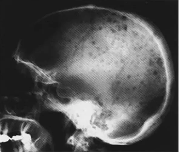 Рис 530 Рентгенограмма черепа больного с ММ иллюстрирующая многочисленные - фото 13
