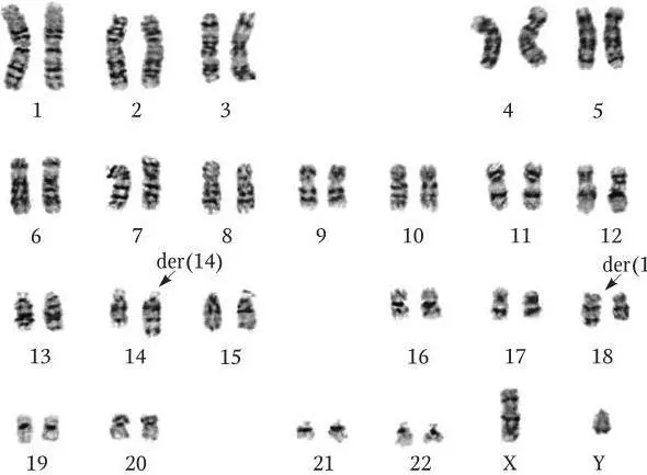 Рис 531 Кариотип клетки крови стимулированной Pokweedантигеном больного с - фото 16