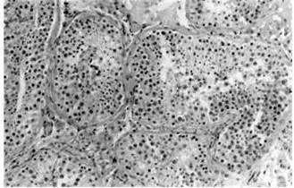 Рис 213 Гипосперматогенез Рис 214 Асперматогенез Рис 215 Синдром - фото 15