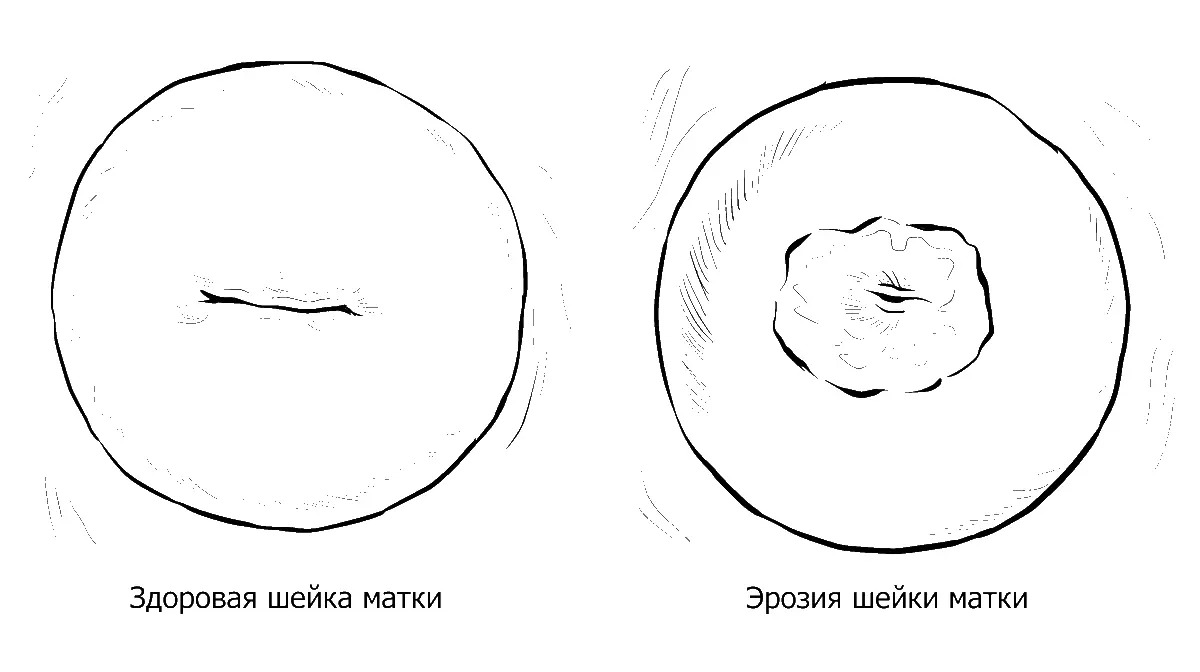 Эрозия или правильнее говорить эктопия шейки матки по сути является - фото 22
