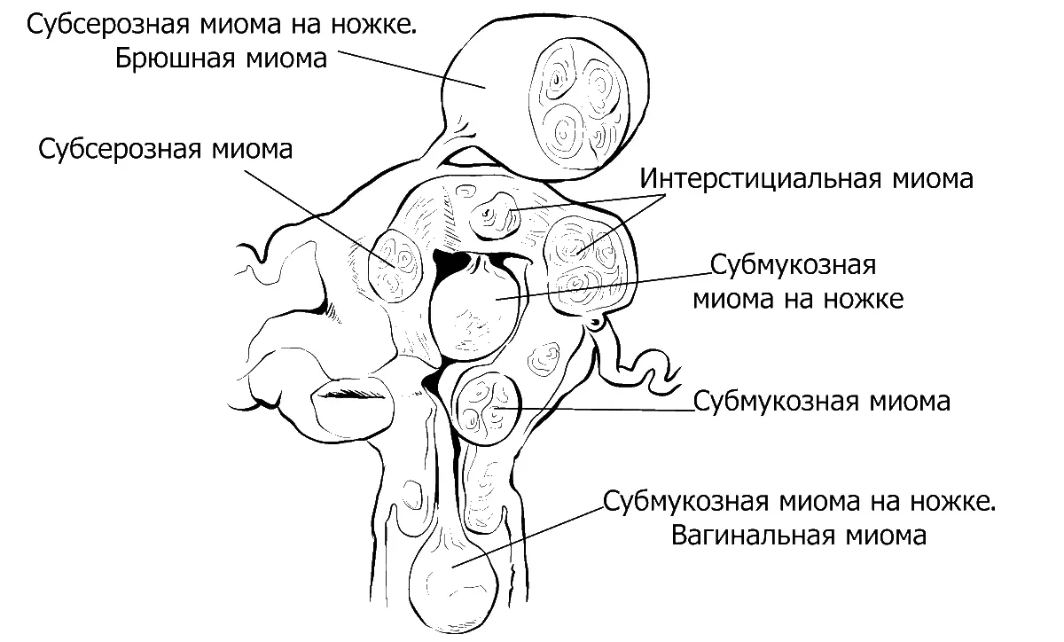 Миома это всегда доброкачественное образование матки раньше ее относили к - фото 23